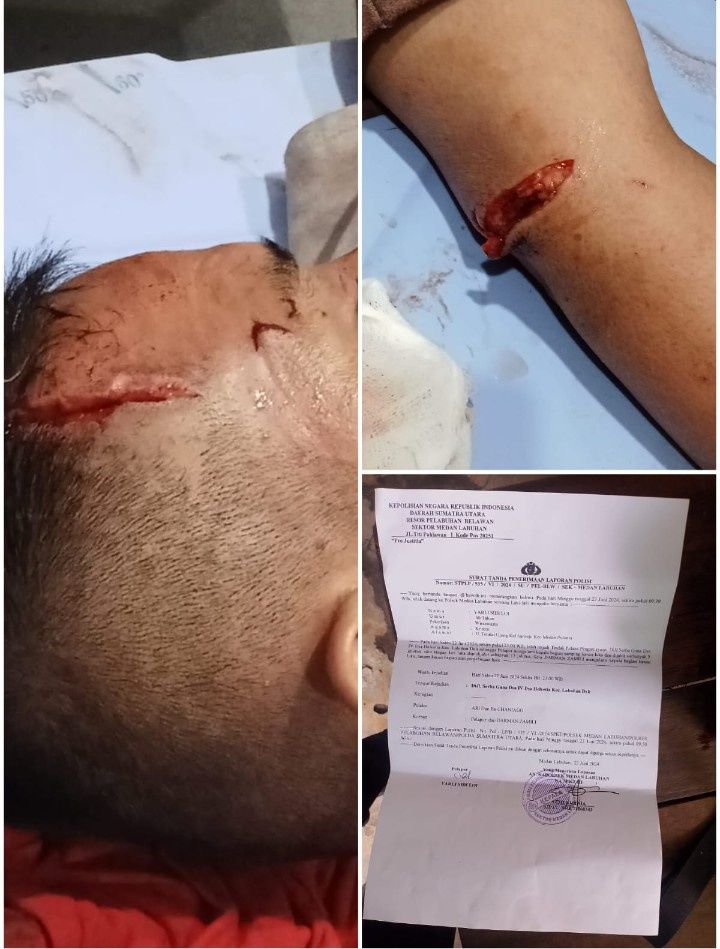 Minta Keadilan, Korban Bacok Yarli Sidi Loi Harapkan Pelaku Segera Ditangkap Polsek Medan Labuhan